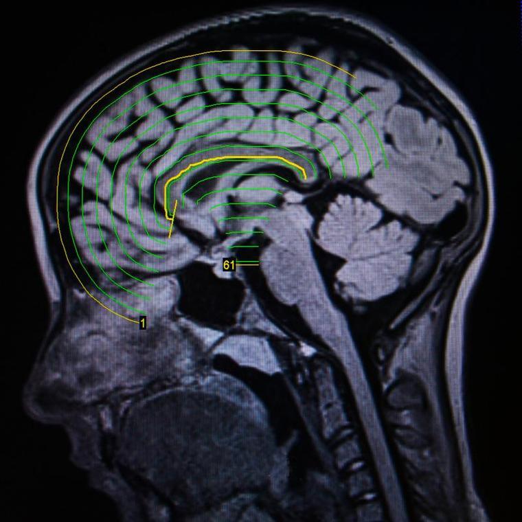 濒死体验的共同特征_濒死体验实例